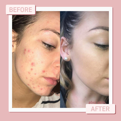 Alya Skin Multi-Complex Facial Oil real results before after
