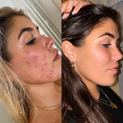 Eco Tan Clear Skin System customer's before after results